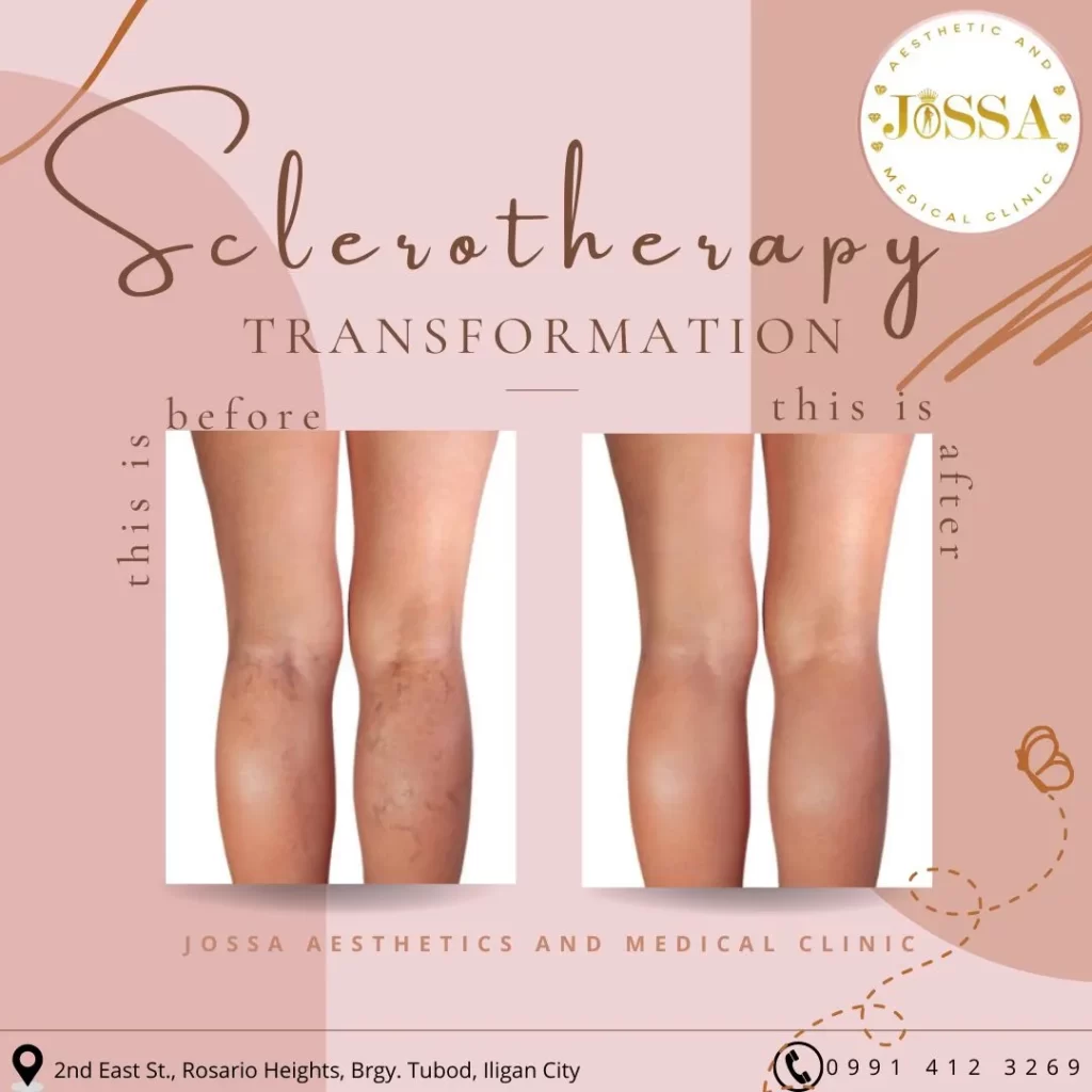 Sclerotherapy treatment before and after